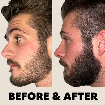 Beard Derma Roller for Thicker-Looking Facial Hair